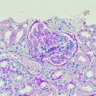 Lupus Nephritis