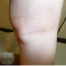 In the pediatric age group, popliteal cysts are the most common lesion behind the knee