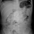 Abdominal x-ray antero-posterior view. 