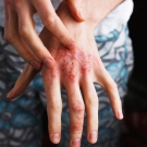 Person scratching hand with plaque psoriasis