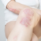 Close up of psoriasis on leg and arm