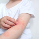 Child scratching arm with plaque psoriasis