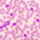 Chronic Lymphocytic Leukemia