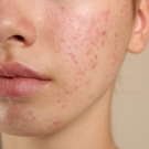 face with acne