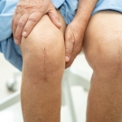 knees after knee replacement surgery