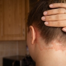 Person with plaque psoriasis on back of neck