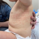 multiple coalescent small erythematous papules on the left rib cage