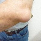 Olecranon bursitis 