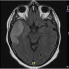 MRI illuminated cortical and subcortical lesion within the right temporal lobe that extends to the right insula.