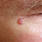 Close-up of Nodular Basal Cell Carcinoma