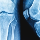 scan of knee bones