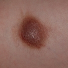 solitary cutaneous mastocytoma 