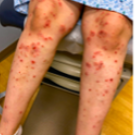 Widespread urticarial plaques with tense bullae over the patients' legs