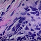 Sections of the resected intranasal lesion 