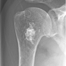 AP radiograph of the right shoulder indicates radiopaque lesion of proximal humerus.