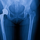 hip replacement imaging