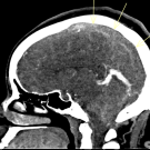 Complete occlusive thrombosis of the superior sagittal sinus. 