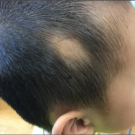 Figure 1. An 8-year-old boy presents with symmetric bald patches since birth in the temporal area.