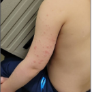 Fig. 2. Posterior left arm