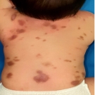 polymorphic maculopapular cutaneous mastocytosis 