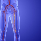 X-ray image of person with Peripheral Artery Disease