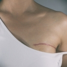 mastectomy scar