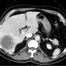 Initial CT scan showing hepatic abscess