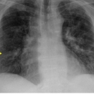 Portable CXR illustrating areas of diffuse pulmonary infiltration (yellow arrows).