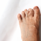 A foot with gouty arthritis 