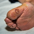 Diabetic foot ulcer