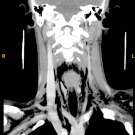 The patient’s soft tissue neck CT with contrast is shown.