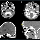 CT head non-contrast axial and coronal views during first visit to emergency department are shown