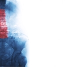 X-ray of spine pain