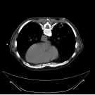 Figure 1. The biopsy needle penetrating the right lower lobe lung mass during CT-guided lung biopsy. The patient was in the prone position.
