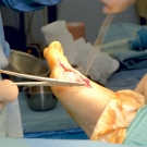 Surgical procedure on foot