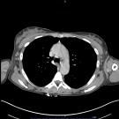 Computed tomography angiography (CTA) showing aortic dissection in a patient with systemic lupus erythematosus (SLE).
