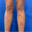 Fitzpatrick Skin Type III female with exquisitely tender, brownish-red, poorly demarcated, subcutaneous nodules on the bilateral anterior shins. 