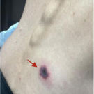 This image shows the patient’s back with 1.8 cm hemorrhagic plaque with central vesicles