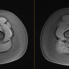 Pre (left) and Post-contrast (right) axial T1-weighted MR image 