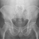 Anterior posterior (AP) radiograph of the pelvis is shown. 