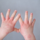 baby's hands with rash