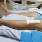 knee replacement surgery after operation