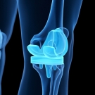knee replacement