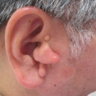 Multiple accessory tragus.