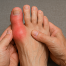 gout image