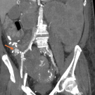 Thick multiplanar reformatted (MPR) coronal computed tomography (CT) in the arterial phase demonstrates a large pseudoaneurysm (arrow) arising from the pancreatic transplant arterial anastomosis.  