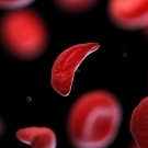 sickle cell