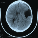 Arachnoid Cyst in a 7-year-old girl