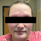 The patient presented with a rash that started on her abdomen, but spread to her face as well as her shins, groin, wrists, and arms.