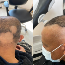 Several nonscarring alopecia patches at baseline.